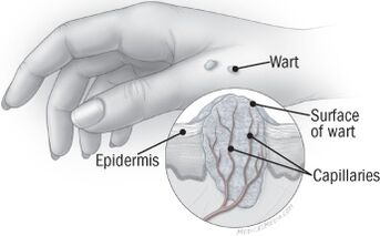 A estrutura da verruga na man