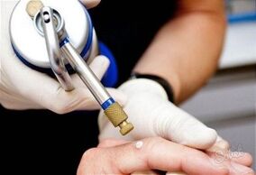Métodos para eliminar papilomas cutáneos