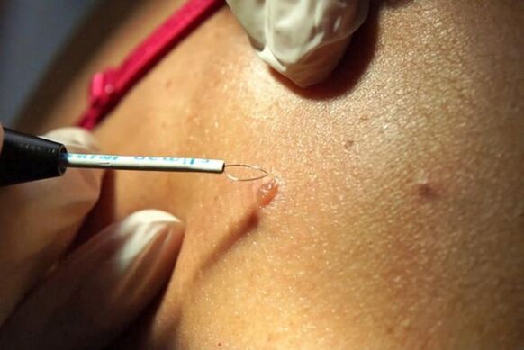 Eliminación de verrugas no corpo