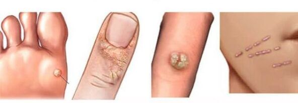 Tipos de verrugas no corpo humano